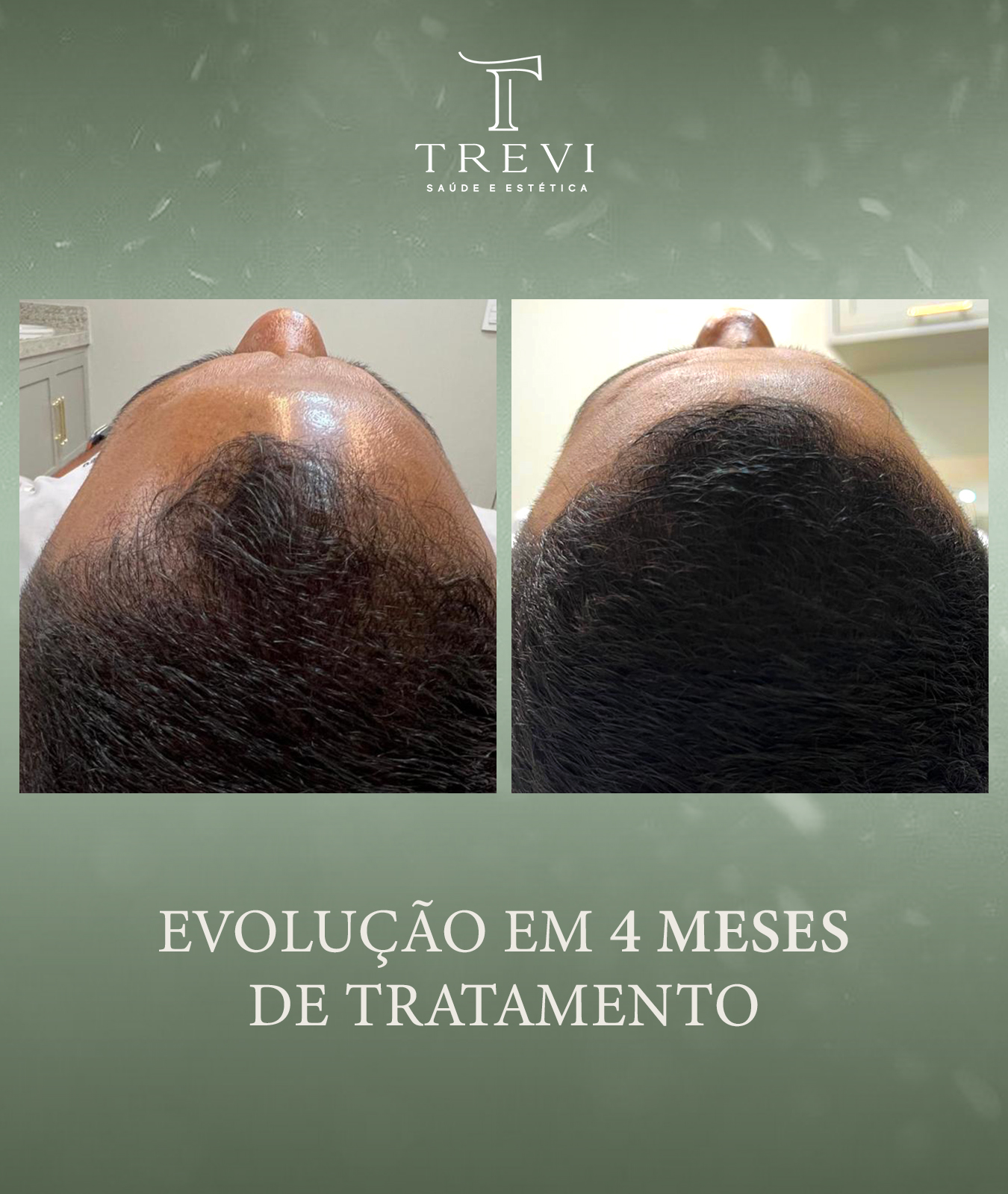 trevi - 4 meses - caio